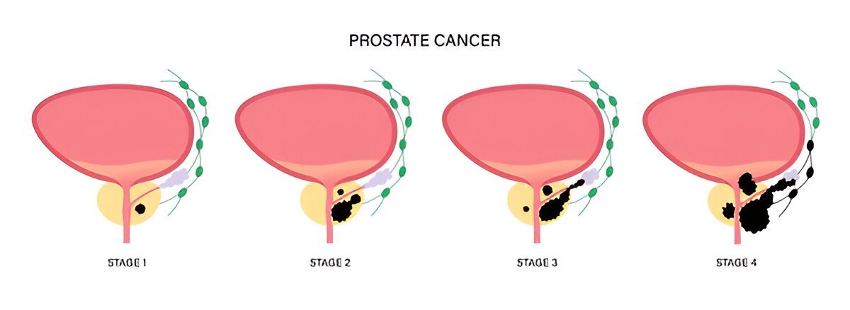 Prostate cancer stages I Phillip E Miles