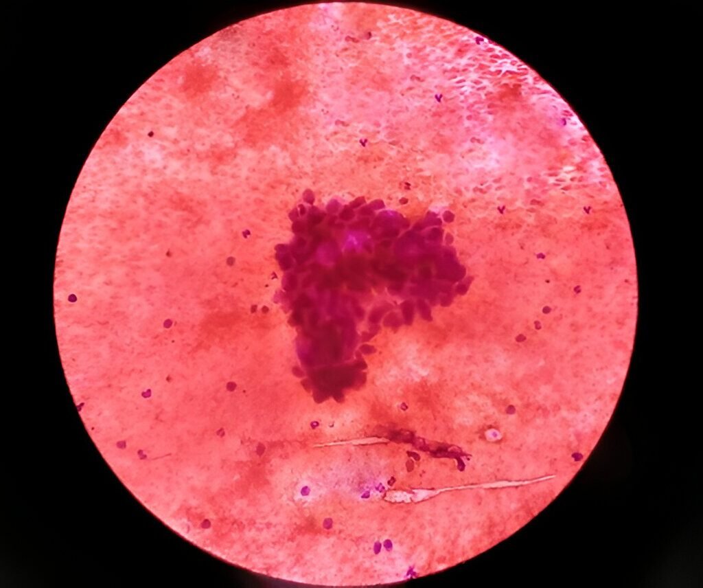 Lung cancer cells under microscope I Phillip E Miles I CurePoint Cancer Center